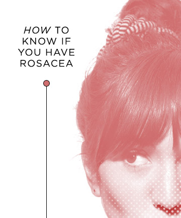 How to Know if You Have Rosacea