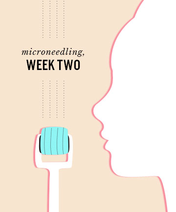 Microneedling, Week Two