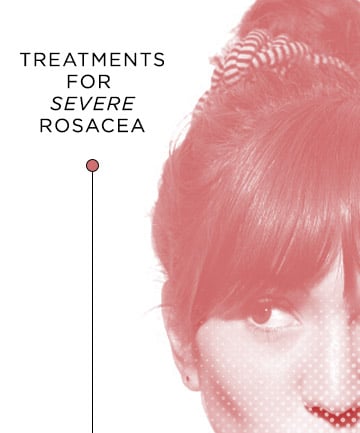 Treatments for Severe Rosacea