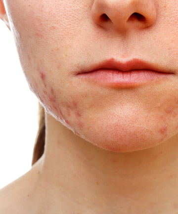 What Chin Acne Looks Like