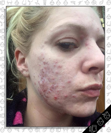 Chemical Peel Leaves Woman With Cystic Acne-Covered Face