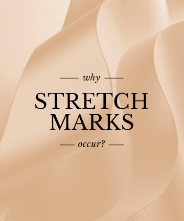 Why Do Stretch Marks Occur?