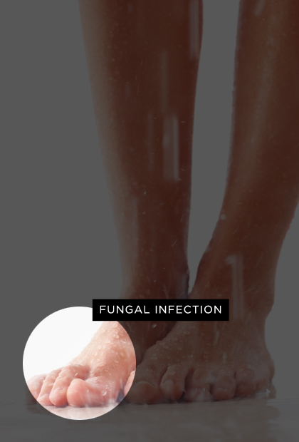 Fungal or yeast infection (aka Athlete's Foot)
