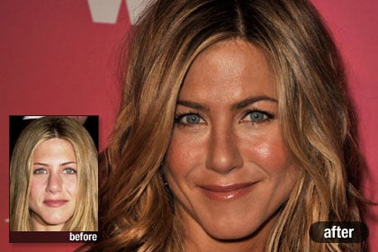 Jennifer Aniston plastic surgery before and after photo