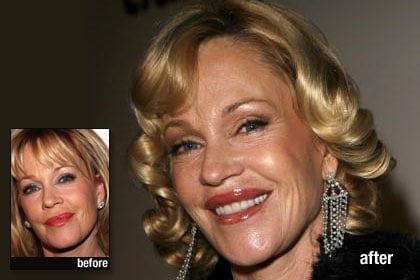  Celebrity Plastic Surgery on The Worst  Melanie Griffith  Best And Worst Celebrity Plastic Surgery