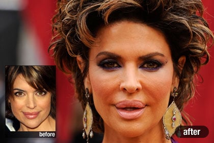 Celebrity Plastic Surgery Pictures on The Worst  Lisa Rinna  Best And Worst Celebrity Plastic Surgery