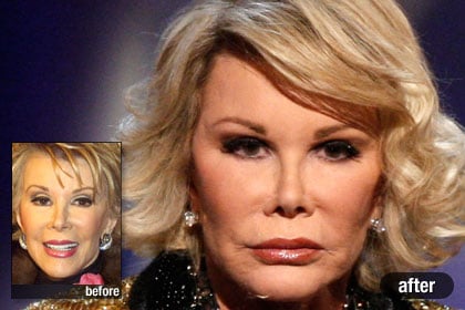  Celebrity Plastic Surgery on The Worst  Joan Rivers  Best And Worst Celebrity Plastic Surgery