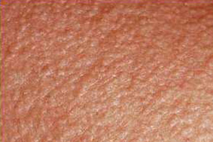 Skin Emergency: Heat Rash