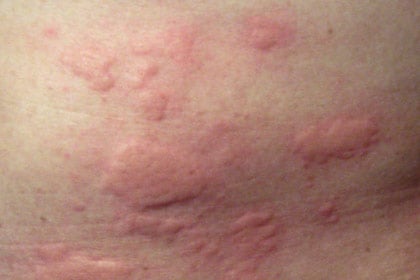 Skin Emergency: Hives