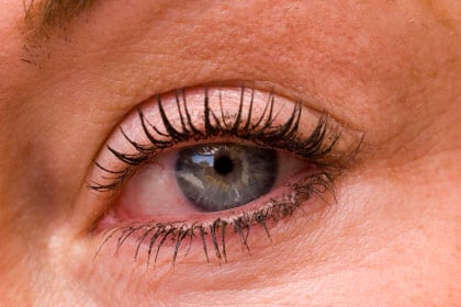 Skin Emergency: Swollen, Red Eyes 