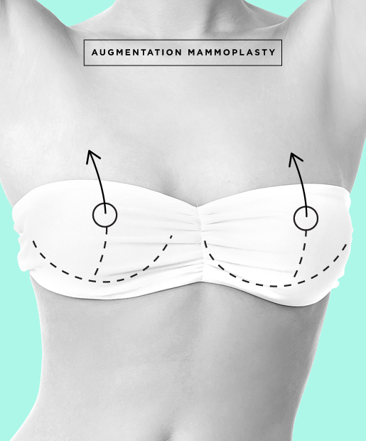 Breast Augmentation aka Augmentation Mammoplasty