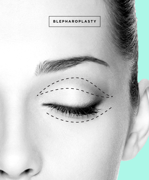 Eyelid Surgery aka Blepharoplasty