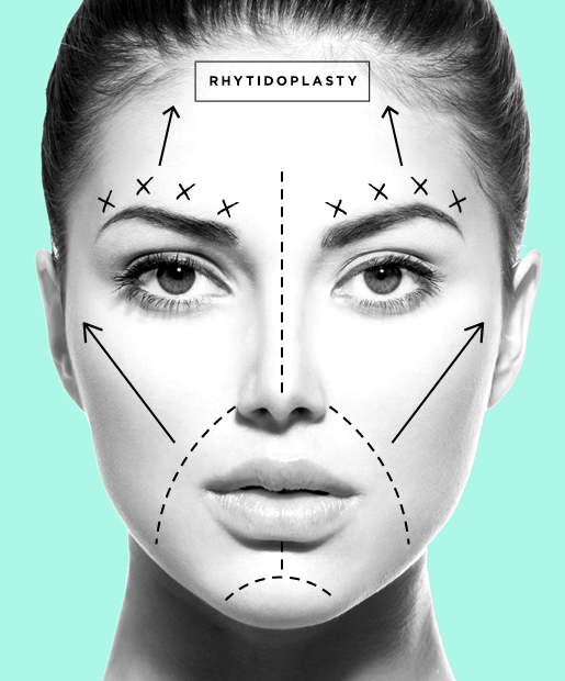 Facelift aka Rhytidoplasty