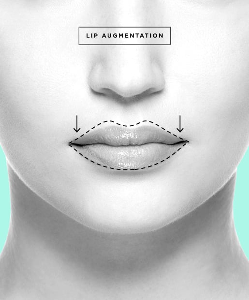 Lip Augmentation aka Lip Enhancement 