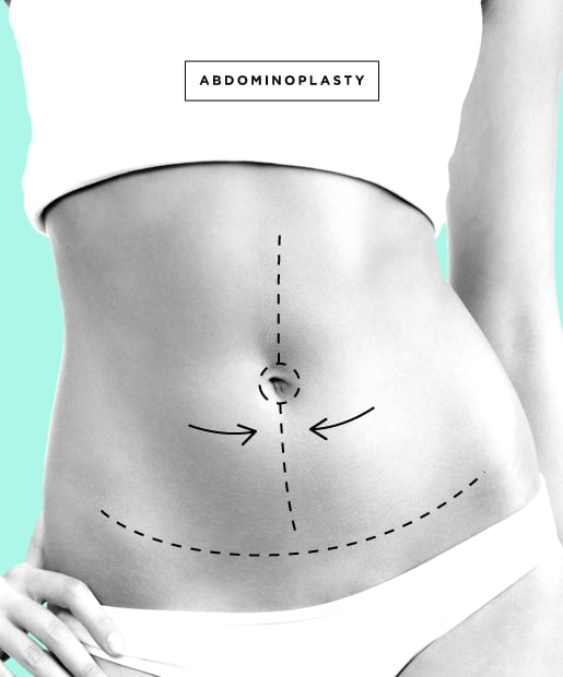 Tummy Tuck aka Abdominoplasty