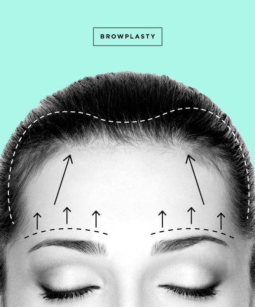 Forehead Lift/Brow Lift aka Browplasty