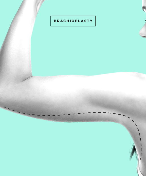 Arm Lift aka Brachioplasty