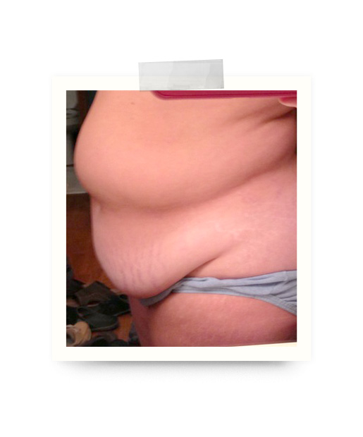20 Pounds Weight Loss After Abdominoplasty