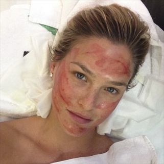 Bar Refaeli Instagrams Her Alarming Vampire Facelift