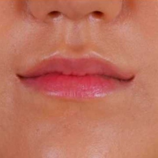 Plastic Surgery For The Shape Of Your Smile