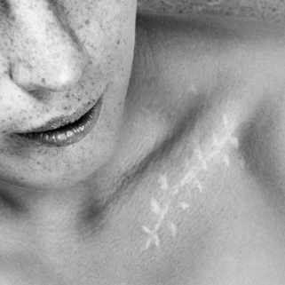6 Best Scar Treatments