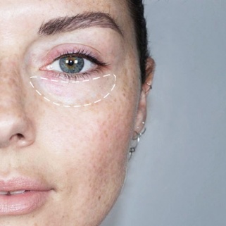 How to Erase Dark Circles With Makeup
