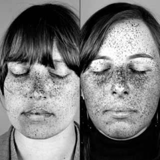 Sun Damage Pics That Will Scare You into Using SPF