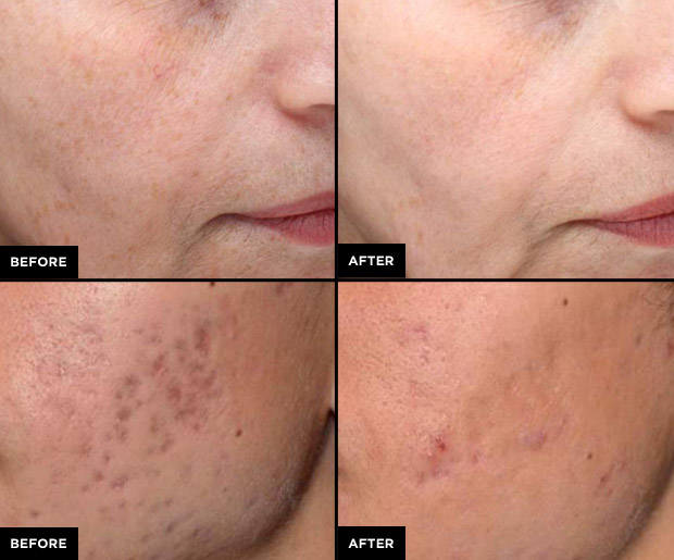 Picosure laser for acne scars