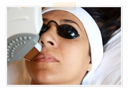 The fractional laser device The fractional laser device
