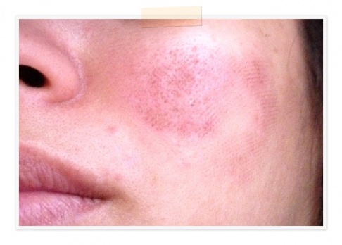 Facial scabbing between treatments Facial scabbing between treatments