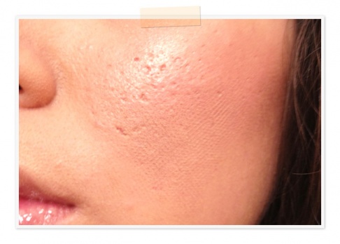 The waffle-print, visible even through makeup The waffle-print, visible even through makeup