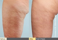 New Procedure Claims to Reduce Cellulite in Just One Treatment! 