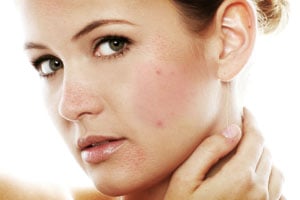 homemade acne treatments