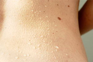 Quiz: Is That Mole Skin Cancer?