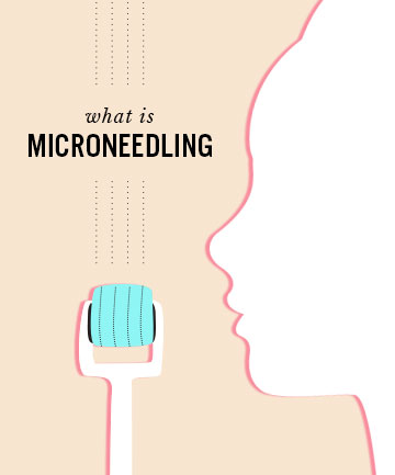What is Microneedling, Anyway? 
