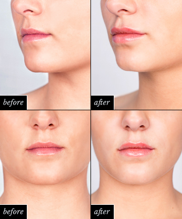 Lip Injections: The Results (and the Price Tag)