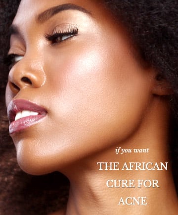 The African Cure for Acne