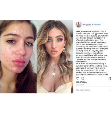 Belle Lucia Pimples Are Officially Cool And These Celebs And Influencers Prove It Page 9