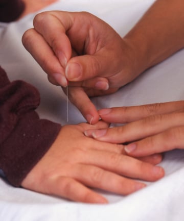 The benefits of acupuncture for children