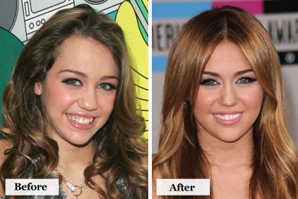 miley cyrus teeth before after