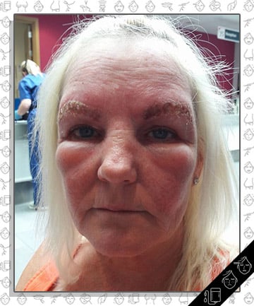 Woman Left With Slugs for Brows After Tinting