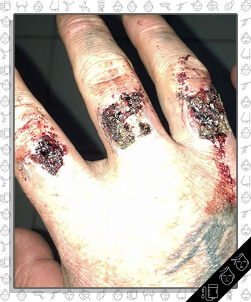 Aussie Man Suffers Horrifying Burns After Attempting to Remove Tattoo