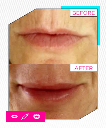Tips for Natural-Looking Lips