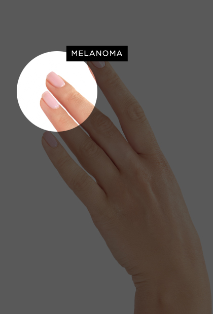 Melanoma | Skin Cancer | Kelowna Skin Cancer Clinic