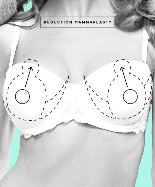 Breast Reduction aka Reduction Mammaplasty
