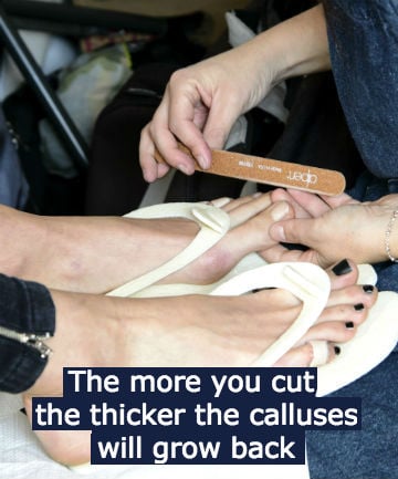 You Don't Need Your Calluses Removed