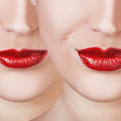 I Got Lip Injections Behind My Husband's Back