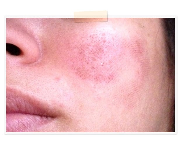 Facial scabbing between treatments